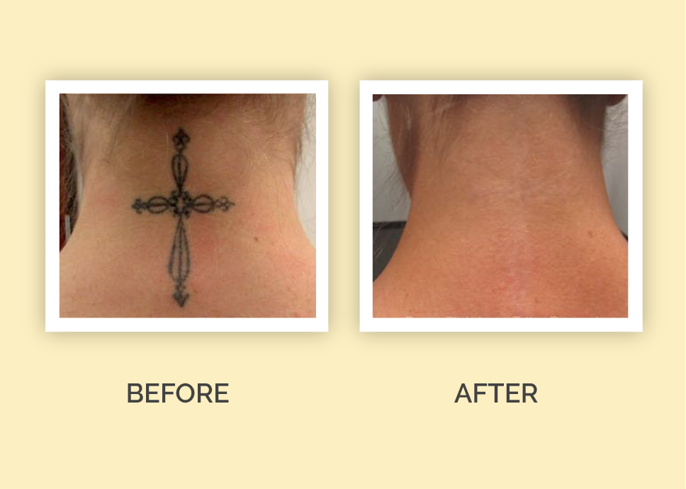 Picosecond Lasers Meeting Advanced Tattoo Removal and Changing  Demographics Needs  Modern Aesthetics